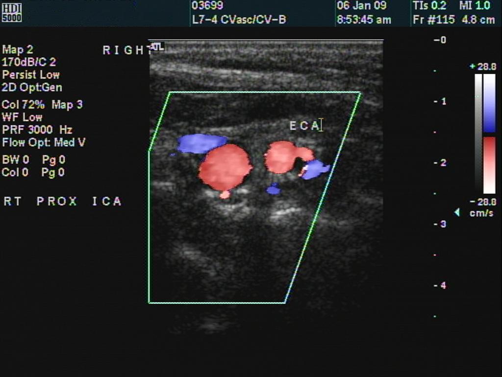 Transverse ICA br