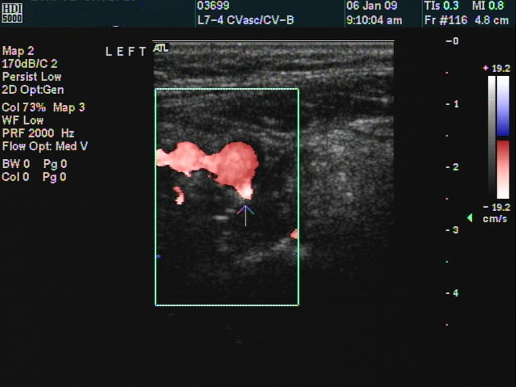 transverse LICA branch