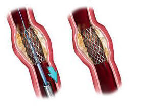 The stent is placed over the balloon and positioned in the narrowed area.  The balloon is inflated which squeezes open the narrowing. When the balloon is deflated, the stent is left in place to help hold the artery open.