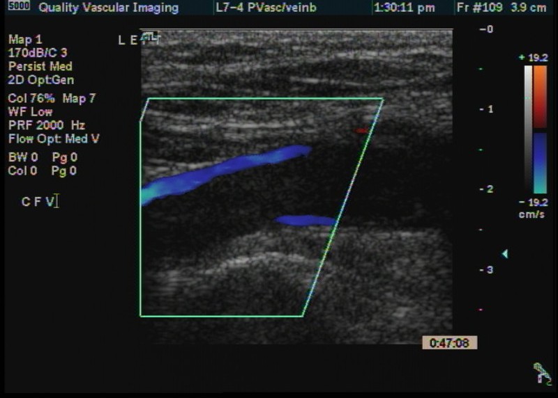 cfv thrombus