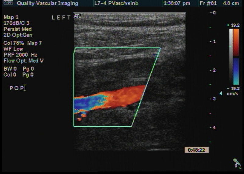 pop thrombus