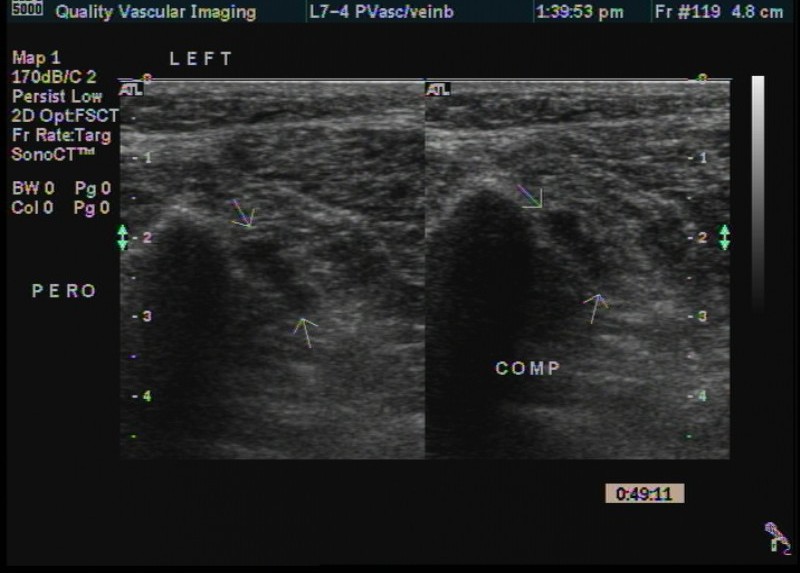 pero thrombus