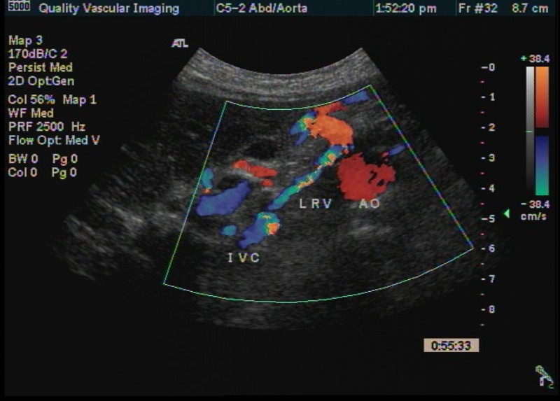 ivc reconstituted