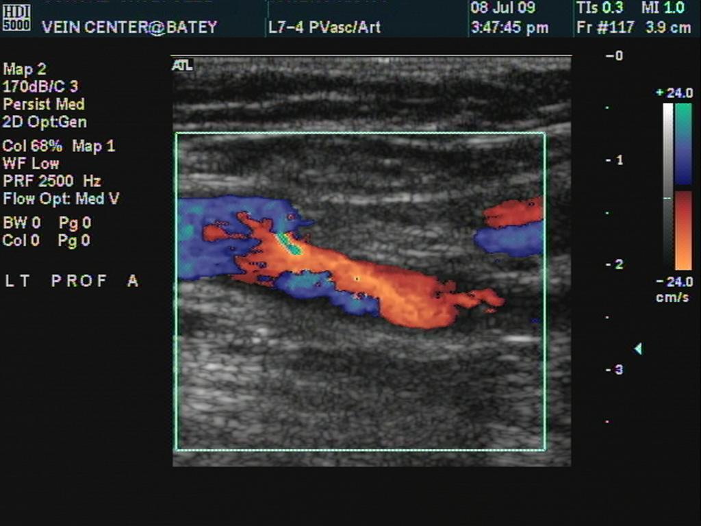 Quality Vascular Imaging-Aberrant leg artery - absent Posterior tibial