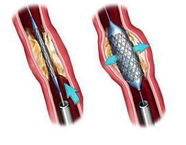 The stent is placed over the balloon and positioned in the narrowed area. The balloon is inflated which squeezes open the narrowing. When the balloon is deflated, the stent is left in place to help hold the artery open. The stent is placed over the balloon and positioned in the narrowed area. The balloon is inflated which squeezes open the narrowing. When the balloon is deflated, the stent is left in place to help hold the artery open.