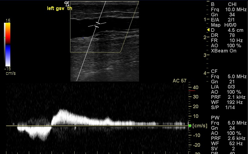 SFJ reflux