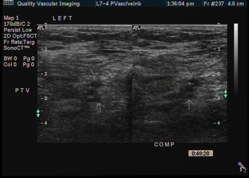 ptv thrombus