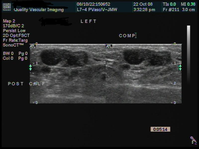 SSV Venous thrombosis