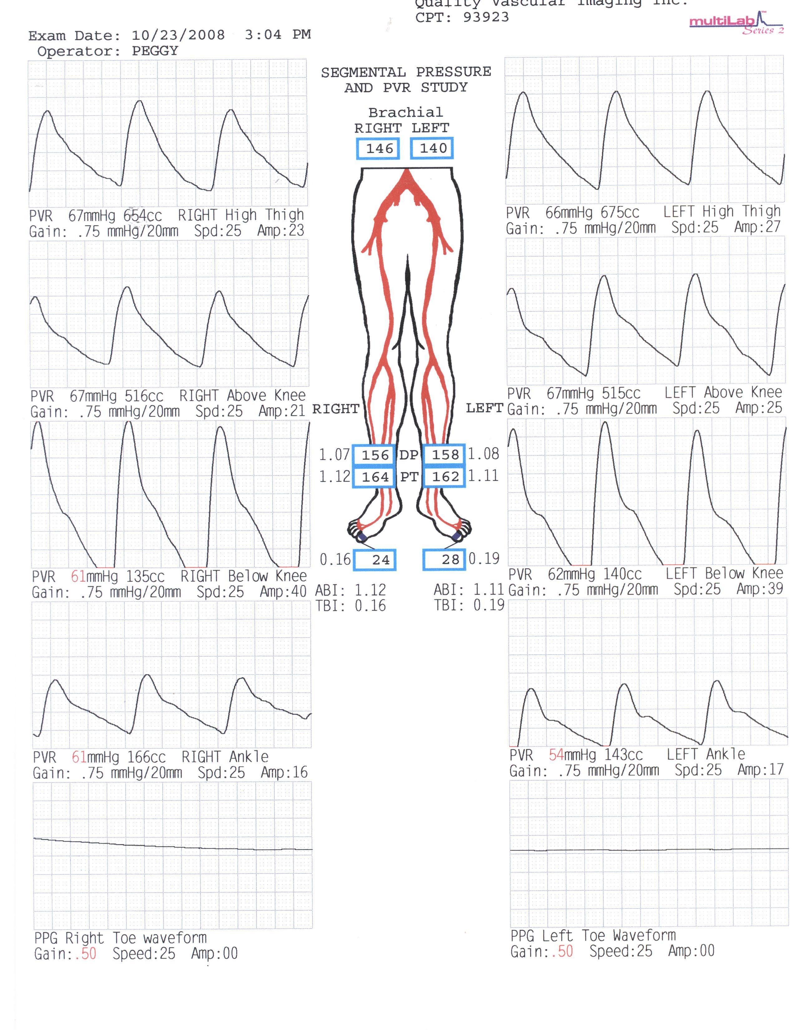 PVR with normal PVR waveforms and flat toe PPG