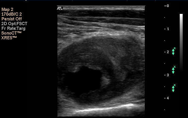 A large aneurysm in the artery behind the knee. Blood clot within this dilatation can break off blocking flow to the foot. 